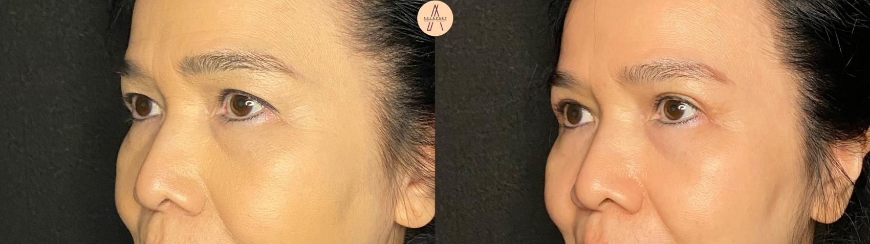 Before & After Upper Blepharoplasty Case 132 Left Oblique View in San Antonio, Texas
