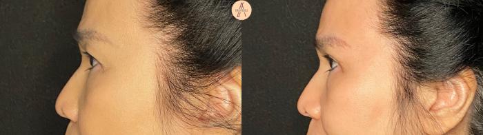 Before & After Upper Blepharoplasty Case 132 Left Side View in San Antonio, Texas