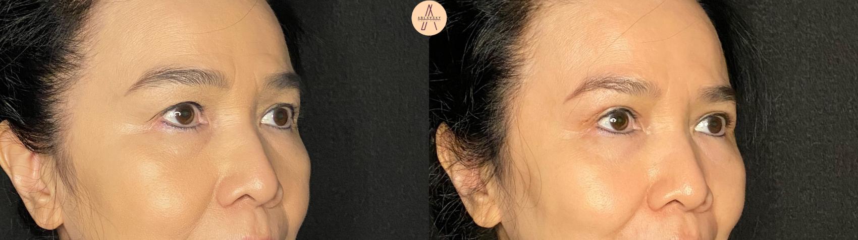 Before & After Upper Blepharoplasty Case 132 Right Oblique View in San Antonio, Texas