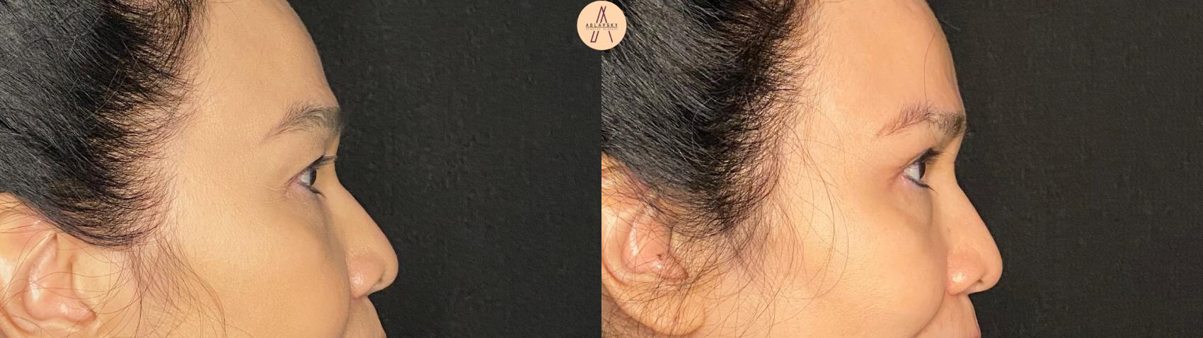 Before & After Upper Blepharoplasty Case 132 Right Side View in San Antonio, Texas