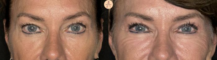 Before & After Upper Blepharoplasty Case 259 Front View in San Antonio, Texas