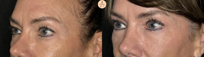 Before & After Upper Blepharoplasty Case 259 Left Oblique View in San Antonio, Texas