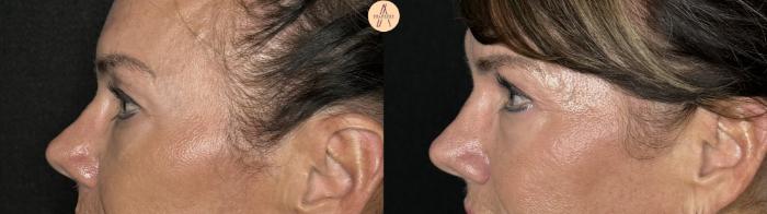 Before & After Upper Blepharoplasty Case 259 Left Side View in San Antonio, Texas