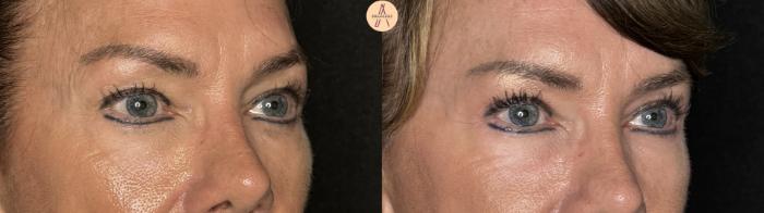 Before & After Upper Blepharoplasty Case 259 Right Oblique View in San Antonio, Texas