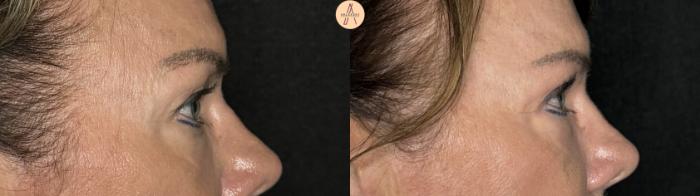 Before & After Upper Blepharoplasty Case 259 Right Side View in San Antonio, Texas