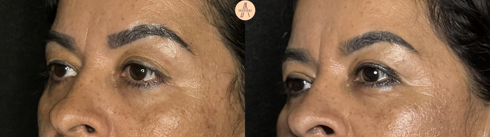 Before & After Upper Blepharoplasty Case 307 Left Oblique View in San Antonio, Texas