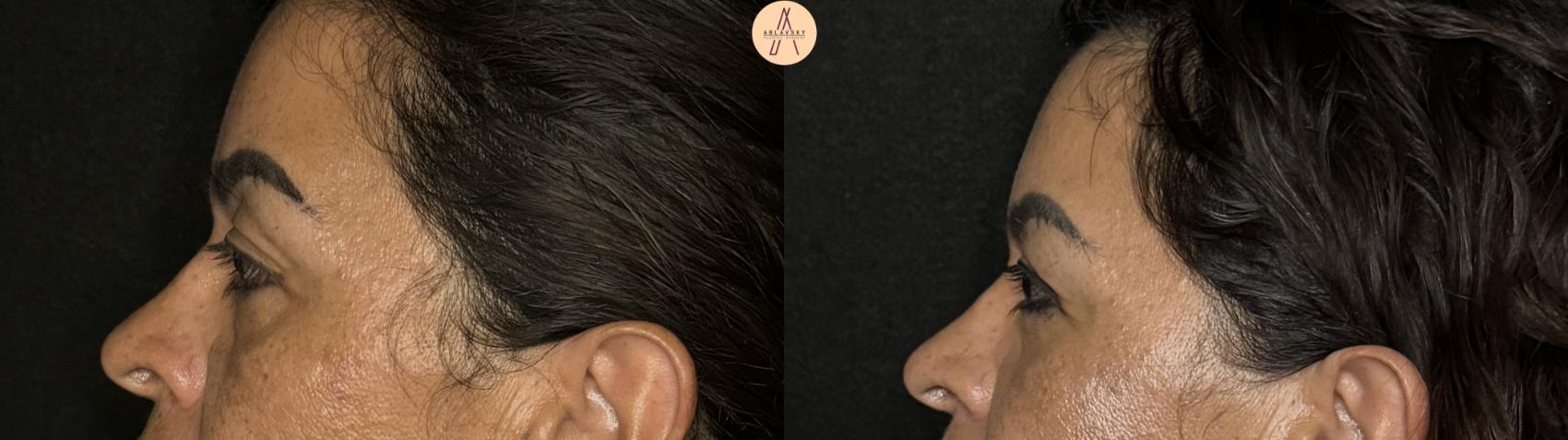 Before & After Upper Blepharoplasty Case 307 Left Side View in San Antonio, Texas