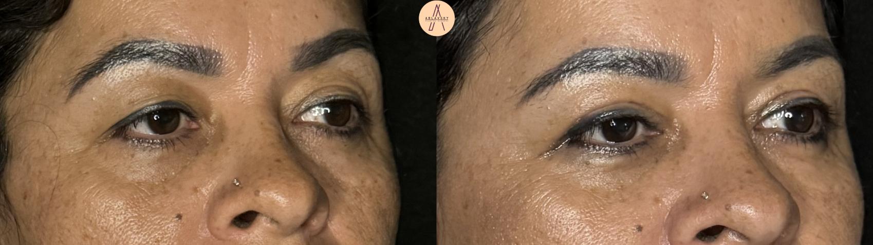 Before & After Upper Blepharoplasty Case 307 Right Oblique View in San Antonio, Texas