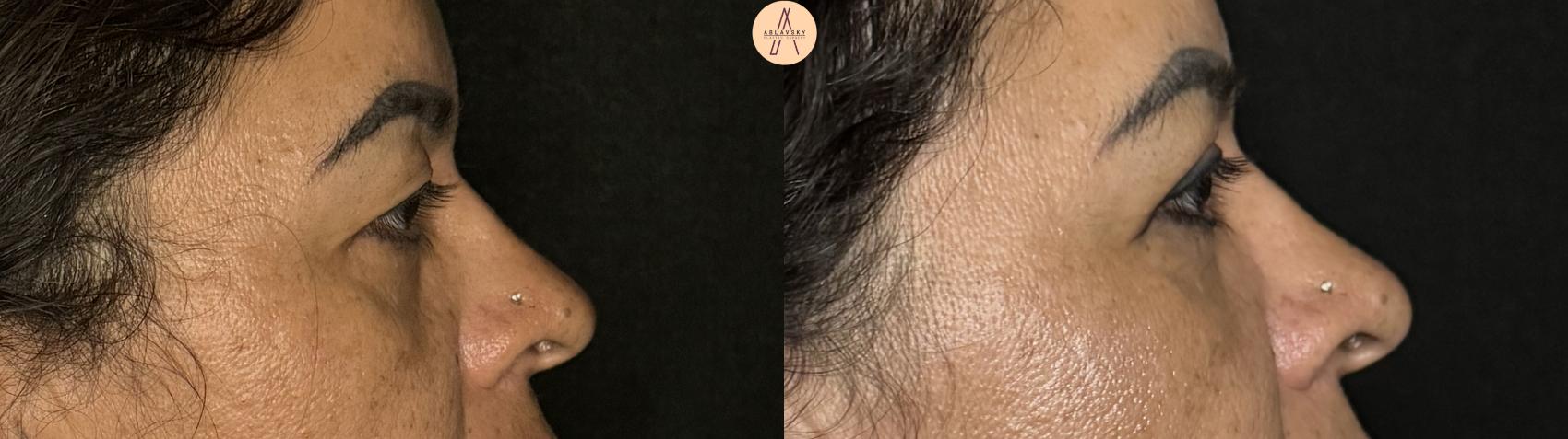 Before & After Upper Blepharoplasty Case 307 Right Side View in San Antonio, Texas