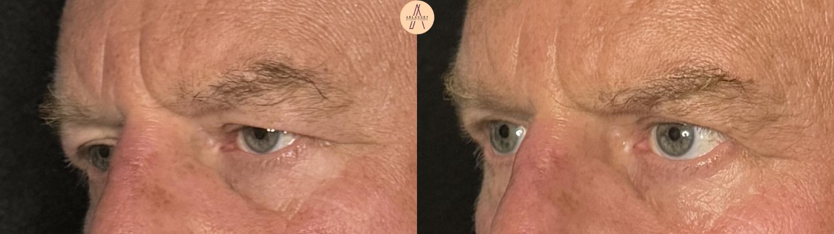 Before & After Upper Blepharoplasty Case 341 Left Oblique View in San Antonio, Texas