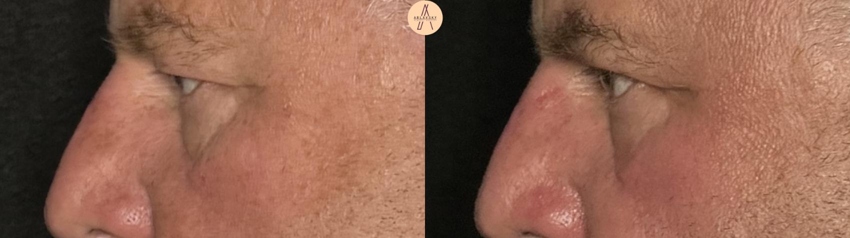 Before & After Upper Blepharoplasty Case 341 Left Side View in San Antonio, Texas