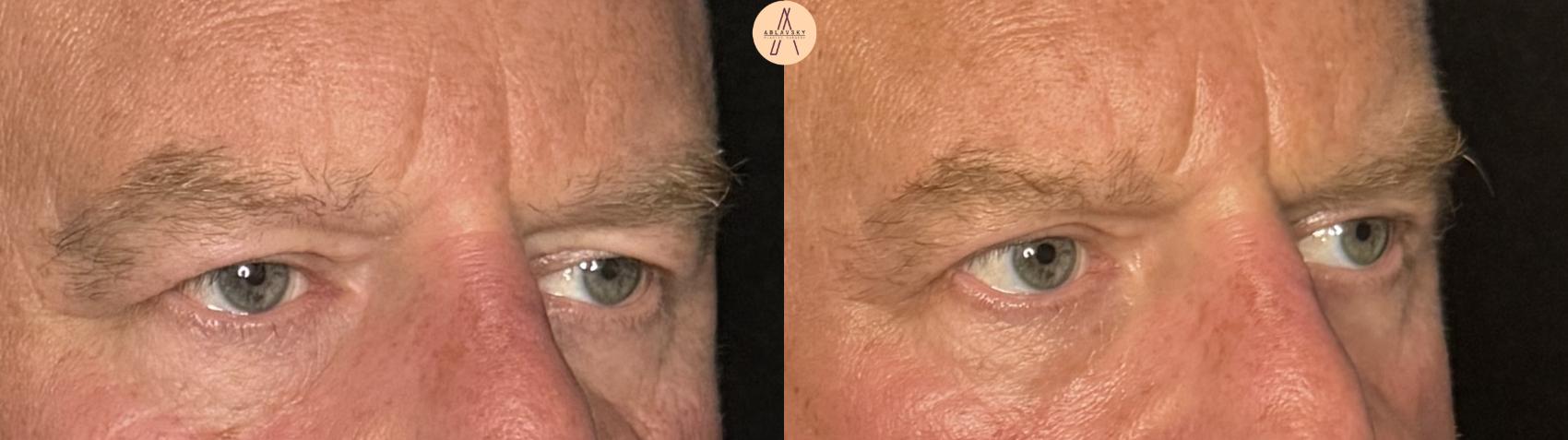 Before & After Upper Blepharoplasty Case 341 Right Oblique View in San Antonio, Texas