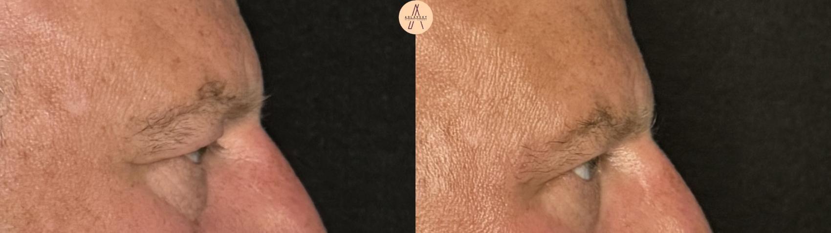 Before & After Upper Blepharoplasty Case 341 Right Side View in San Antonio, Texas