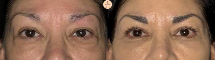 Before & After Upper Blepharoplasty Case 371 Front View in San Antonio, Texas