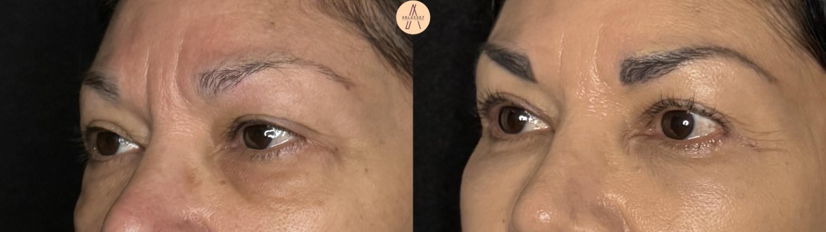 Before & After Upper Blepharoplasty Case 371 Left Oblique View in San Antonio, Texas