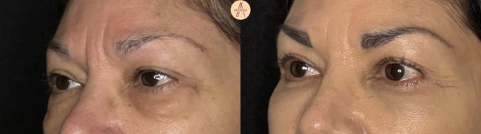 Before & After Upper Blepharoplasty Case 371 Left Oblique View in San Antonio, Texas