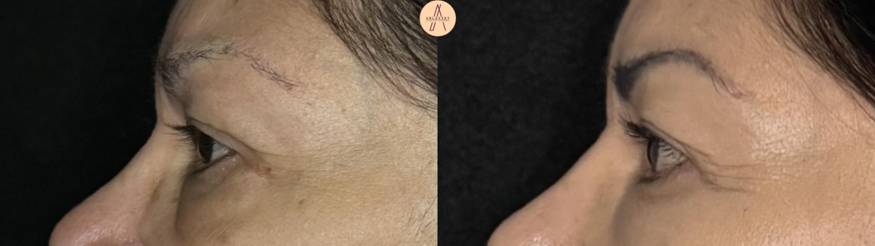 Before & After Upper Blepharoplasty Case 371 Left Side View in San Antonio, Texas