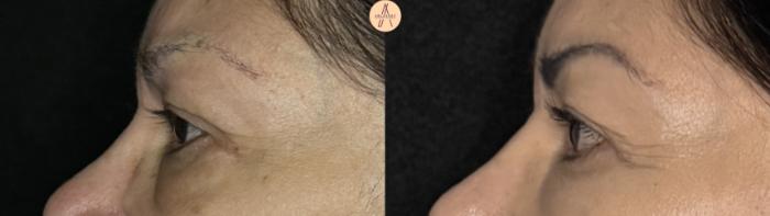 Before & After Upper Blepharoplasty Case 371 Left Side View in San Antonio, Texas