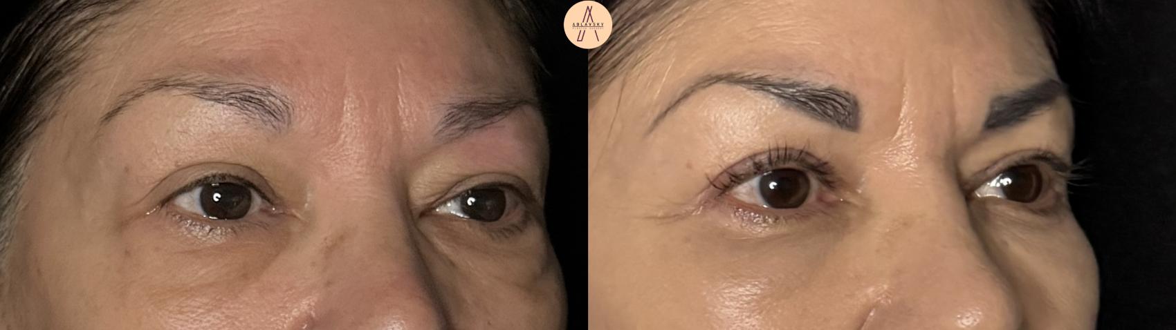 Before & After Upper Blepharoplasty Case 371 Right Oblique View in San Antonio, Texas