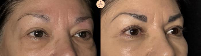 Before & After Upper Blepharoplasty Case 371 Right Oblique View in San Antonio, Texas