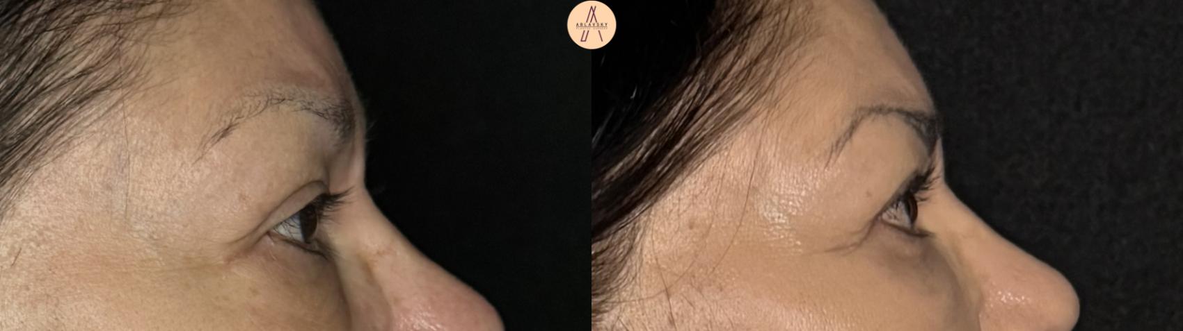 Before & After Upper Blepharoplasty Case 371 Right Side View in San Antonio, Texas