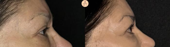 Before & After Upper Blepharoplasty Case 371 Right Side View in San Antonio, Texas