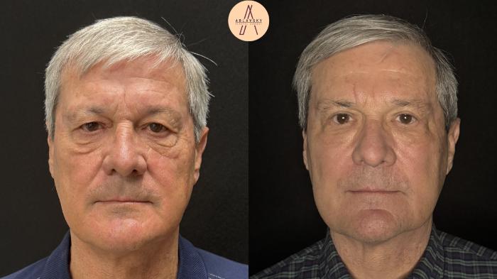 Before & After Upper Blepharoplasty Case 488 Front View in San Antonio, Texas