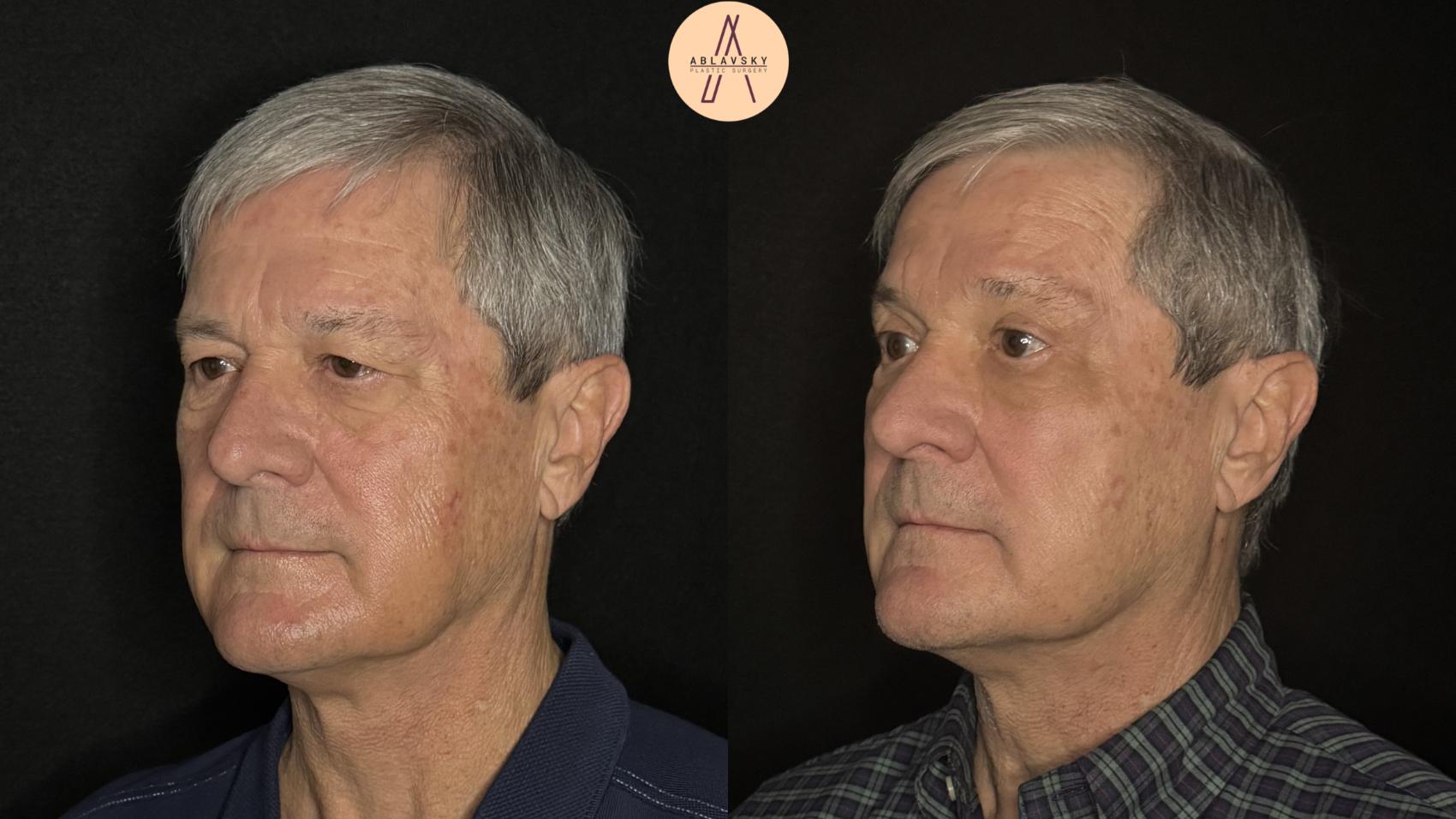 Before & After Upper Blepharoplasty Case 488 Left Oblique View in San Antonio, Texas