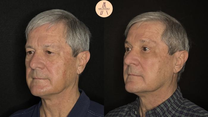 Before & After Upper Blepharoplasty Case 488 Left Oblique View in San Antonio, Texas