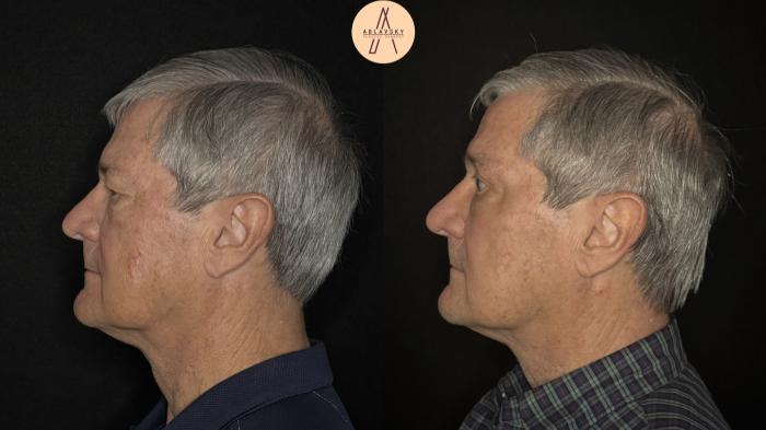 Before & After Upper Blepharoplasty Case 488 Left Side View in San Antonio, Texas