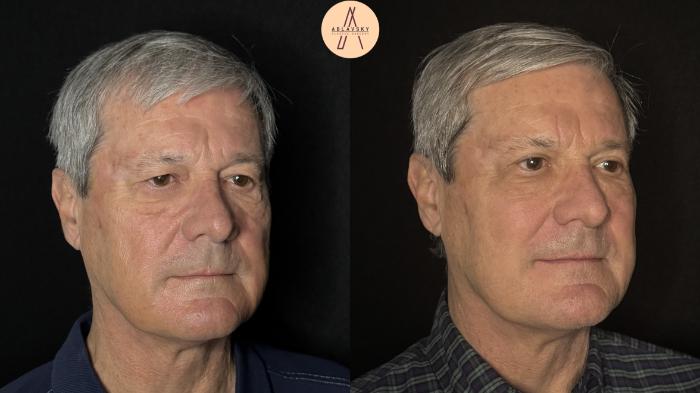 Before & After Upper Blepharoplasty Case 488 Right Oblique View in San Antonio, Texas
