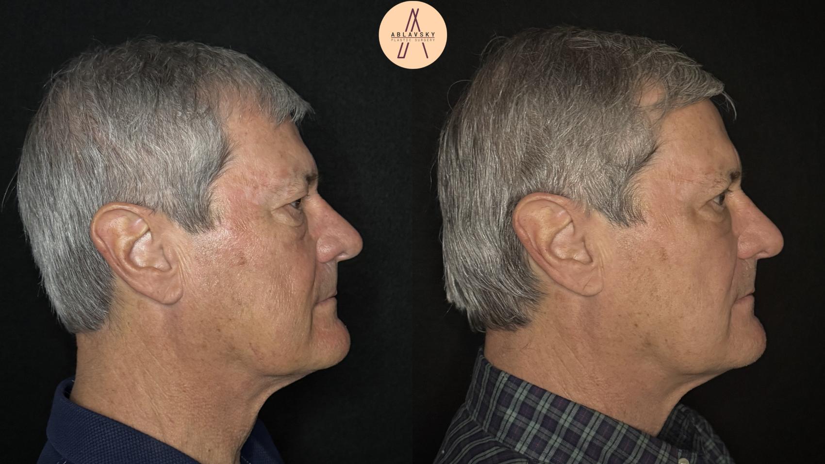 Before & After Upper Blepharoplasty Case 488 Right Side View in San Antonio, Texas