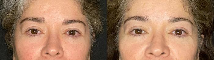 Before & After Upper Blepharoplasty Case 49 Front View in San Antonio, Texas