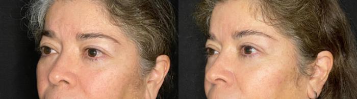 Before & After Upper Blepharoplasty Case 49 Left Oblique View in San Antonio, Texas