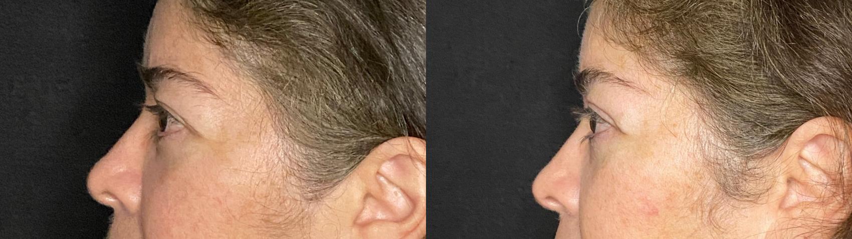 Before & After Upper Blepharoplasty Case 49 Left Side View in San Antonio, Texas