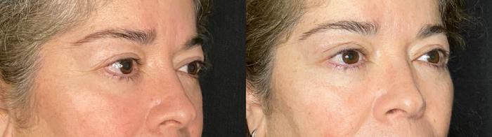Before & After Upper Blepharoplasty Case 49 Right Oblique View in San Antonio, Texas
