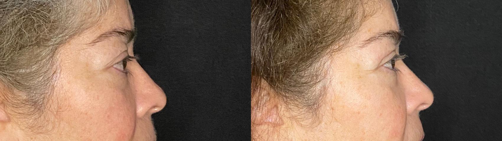 Before & After Upper Blepharoplasty Case 49 Right Side View in San Antonio, Texas