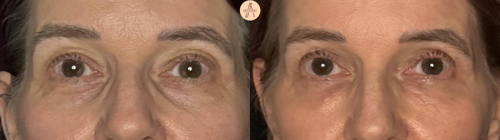 Before & After Upper Blepharoplasty Case 513 Front View in San Antonio, Texas