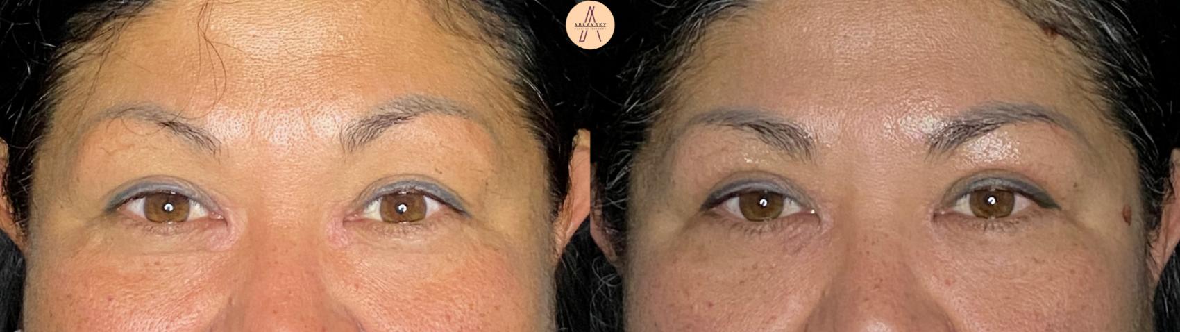 Before & After Upper Blepharoplasty Case 63 Front View in San Antonio, Texas