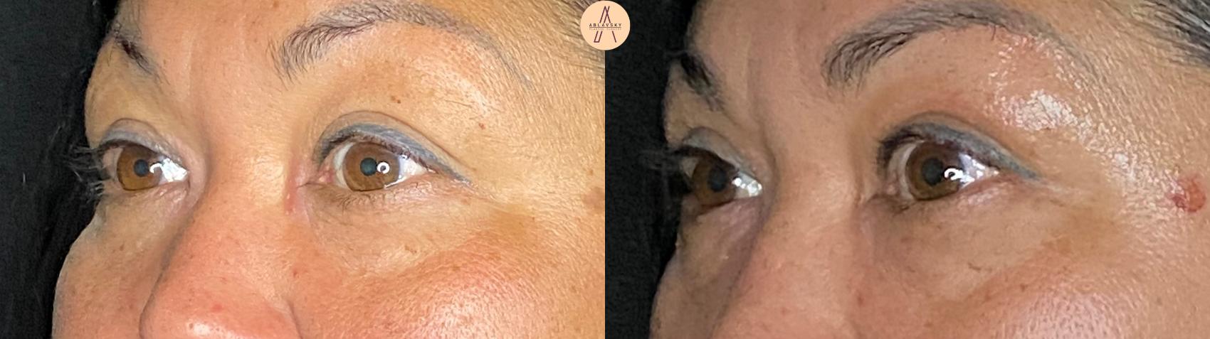 Before & After Upper Blepharoplasty Case 63 Left Oblique View in San Antonio, Texas