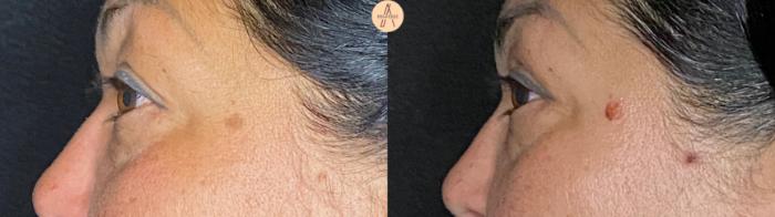 Before & After Upper Blepharoplasty Case 63 Left Side View in San Antonio, Texas