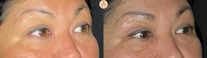 Before & After Upper Blepharoplasty Case 63 Right Oblique View in San Antonio, Texas